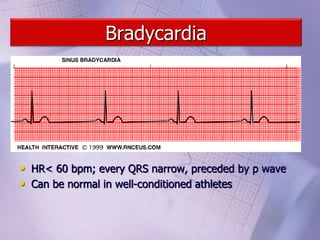Bradycardia
• HR< 60 bpm; every QRS narrow, preceded by p wave
• Can be normal in well-conditioned athletes
 