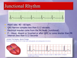 Junctional Rhythm
• Heart rate: 40 – 60 bpm.
• QRS Narrow complex less than 0.12 seconds.
• Electrical impulse come from the AV Node (Junctional).
• P – Wave: Absent or Inverted or after QRS, or come shorter than PR
Interval (less than 0.12 Seconds
 