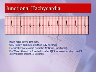 Junctional Tachycardia
• Heart rate: above 100 bpm.
• QRS Narrow complex less than 0.12 seconds.
• Electrical impulse come from the AV Node (Junctional).
• P – Wave: Absent or Inverted or after QRS, or come shorter than PR
Interval (less than 0.12 Seconds
 