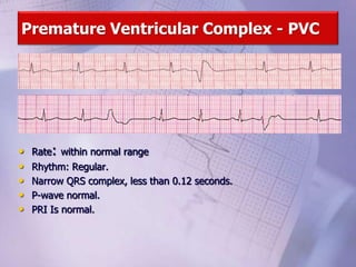 Premature Ventricular Complex - PVC
• Rate: within normal range
• Rhythm: Regular.
• Narrow QRS complex, less than 0.12 seconds.
• P-wave normal.
• PRI Is normal.
 