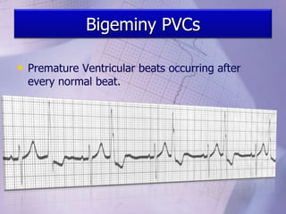 Bigeminy PVCs
• Premature Ventricular beats occurring after
every normal beat.
 