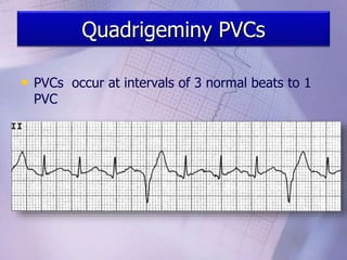 Quadrigeminy PVCs
• PVCs occur at intervals of 3 normal beats to 1
PVC
 