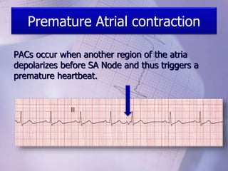 Premature Atrial contraction
PACs occur when another region of the atria
depolarizes before SA Node and thus triggers a
premature heartbeat.
 