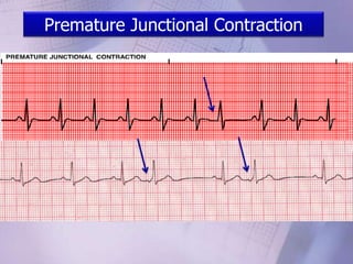 Premature Junctional Contraction
 