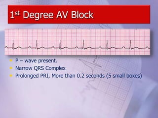 1st Degree AV Block
• P – wave present.
• Narrow QRS Complex
• Prolonged PRI, More than 0.2 seconds (5 small boxes)
 