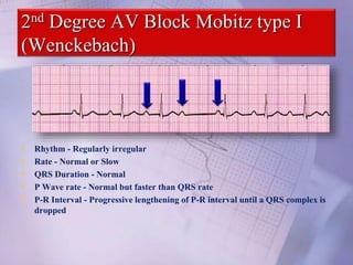 2nd Degree AV Block Mobitz type I
(Wenckebach)
• Rhythm - Regularly irregular
• Rate - Normal or Slow
• QRS Duration - Normal
• P Wave rate - Normal but faster than QRS rate
• P-R Interval - Progressive lengthening of P-R interval until a QRS complex is
dropped
 