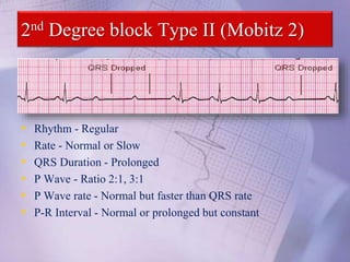 2nd Degree block Type II (Mobitz 2)
• Rhythm - Regular
• Rate - Normal or Slow
• QRS Duration - Prolonged
• P Wave - Ratio 2:1, 3:1
• P Wave rate - Normal but faster than QRS rate
• P-R Interval - Normal or prolonged but constant
 