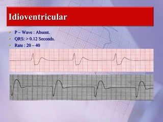 Idioventricular
• P – Wave : Absent.
• QRS: > 0.12 Seconds.
• Rate : 20 – 40
 