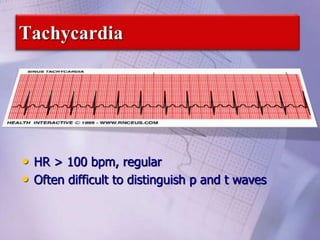 • HR > 100 bpm, regular
• Often difficult to distinguish p and t waves
 
