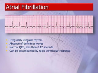 Atrial Fibrillation
• Irregularly irregular rhythm
• Absence of definite p waves
• Narrow QRS, less than 0.12 seconds
• Can be accompanied by rapid ventricular response
 