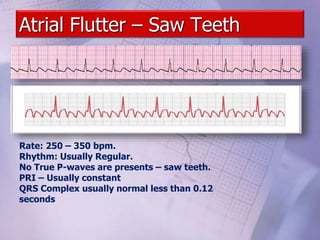 Atrial Flutter – Saw Teeth
Rate: 250 – 350 bpm.
Rhythm: Usually Regular.
No True P-waves are presents – saw teeth.
PRI – Usually constant
QRS Complex usually normal less than 0.12
seconds
 