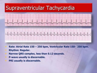 Supraventricular Tachycardia
• Rate: Atrial Rate 150 – 250 bpm, Ventricular Rate 150- 250 bpm.
• Rhythm: Regular.
• Narrow QRS complex, less than 0.12 seconds.
• P-wave usually is discernable.
• PRI usually is discernable.
 