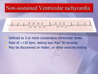 Non-sustained Ventricular tachycardia
• Defined as 3 or more consecutive ventricular beats
• Rate of >120 bpm, lasting less than 30 seconds
• May be discovered on Halter, or other exercise testing
 