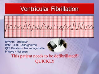 Ventricular Fibrillation
Rhythm - Irregular
Rate - 300+, disorganized
QRS Duration - Not recognizable
P Wave - Not seen
This patient needs to be defibrillated!!
QUICKLY
 