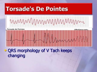 Torsade's De Pointes
• QRS morphology of V Tach keeps
changing
 