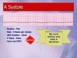 A Systole
• Rhythm - Flat
• Rate - 0 Beats per minute
• QRS Duration - None
• P Wave - None
• Carry out CPR!!
 