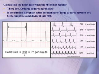 Calculating the heart rate when the rhythm is regular
• There are 300 large squares per minute
• If the rhythm is regular count the number of large squares between two
QRS complexes and divide it into 300.
 
