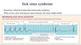 Sick sinus syndrome
• No treatment required unless symptomatic
• If the patient is symptomatic, however, treatment aims to...