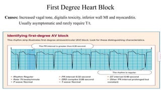 Second Degree AV Block Type 1 (Wenckebach)
• Often seen in post inferior MI with AV node ischemia
• No pacing as long as n...