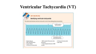 Torsades de Pointes
• French term-Means twisting around the points.
• Special form of polymorphic ventricular tachycardia....