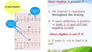 Sinus rhythm is present if :-
1. PR interval is consistent
throughout the tracing
2. P wave deflection is positive
in leads 1, II and aVF but
negative in aVR
-Sinus rhythm is not if 
1. P wave is –ve in lead 2 &
aVF
2. +Ve in aVR
 