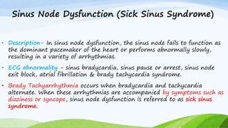 Sinus Node Dysfunction (Sick Sinus Syndrome)
• Description- In sinus node dysfunction, the sinus node fails to function as
the dominant pacemaker of the heart or performs abnormally slowly,
resulting in a variety of arrhythmias.
• ECG abnormality - sinus bradycardia, sinus pause or arrest, sinus node
exit block, atrial fibrillation & brady tachycardia syndrome.
• Brady Tachyarrhythmia occurs when bradycardia and tachycardia
alternate. When these arrhythmias are accompanied by symptoms such as
dizziness or syncope, sinus node dysfunction is referred to as sick sinus
syndrome.
 