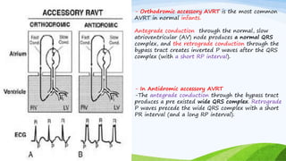 - Orthodromic accessory AVRT is the most common
AVRT in normal infants.
Antegrade conduction through the normal, slow
atrioventricular (AV) node produces a normal QRS
complex, and the retrograde conduction through the
bypass tract creates inverted P waves after the QRS
complex (with a short RP interval).
- In Antidromic accessory AVRT
-The antegrade conduction through the bypass tract
produces a pre existed wide QRS complex. Retrograde
P waves precede the wide QRS complex with a short
PR interval (and a long RP interval).
 