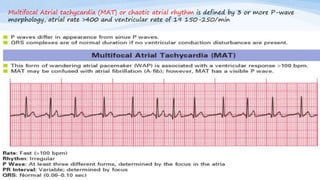 Multifocal Atrial tachycardia (MAT) or chaotic atrial rhythm is defined by 3 or more P-wave
morphology, atrial rate >400 and ventricular rate of 19 150-250/min
 
