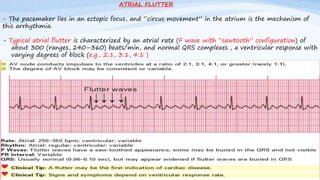 - The pacemaker lies in an ectopic focus, and “circus movement” in the atrium is the mechanism of
this arrhythmia.
- Typical atrial flutter is characterized by an atrial rate (F wave with “sawtooth” configuration) of
about 300 (ranges, 240–360) beats/min, and normal QRS complexes , a ventricular response with
varying degrees of block (e.g., 2:1, 3:1, 4:1 )
ATRIAL FLUTTER
 