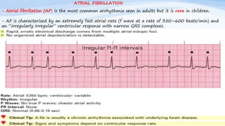 - Atrial fibrillation (AF) is the most common arrhythmia seen in adults but it is rare in children.
- AF is characterized by an extremely fast atrial rate (f wave at a rate of 350–600 beats/min) and
an “irregularly irregular” ventricular response with narrow QRS complexes.
ATRIAL FIBRILLATION
 
