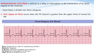 Atrioventricular (AV) block is defined as a delay or interruption in the transmission of an atrial
impulse to the ventricles.
- Heart block is divided into three catogeries.
1. First-degree AV block occurs when the PR interval is greater than the upper limits of normal for
age.
 
