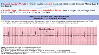 2. Second-degree AV block is further divided into two categories based on ECG findings, Mobitz type 1
and type 2.
- In Mobitz type 1 block (also referred to as Wenckebach block), there is progressive prolongation of
the PR-interval until a P wave fails to be conducted.
 
