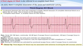 3.Third-degree AV block is also referred to as complete heart block.
On ECG, there is complete dissociation of the atrial and ventricular activity
 
