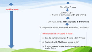 Not visible P wave
AVNRT / JET
( P wave is submerged with QRS wave )
Give Adenosine ( both diagnostic & therapeutic )
If tachycardia breaks down with Adenosine , its AVNRT
Other causes of not visible P wave-
1. Can be superimposed on T wave , tall T Wave
2. Replaced with fibrillatory waves in AF
3. P wave appear as saw tooth appearance as in
Atrial flutter
Visible P wave
 