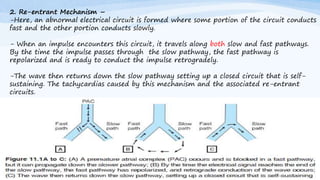 2. Re-entrant Mechanism –
-Here, an abnormal electrical circuit is formed where some portion of the circuit conducts
fast and the other portion conducts slowly.
- When an impulse encounters this circuit, it travels along both slow and fast pathways.
By the time the impulse passes through the slow pathway, the fast pathway is
repolarized and is ready to conduct the impulse retrogradely.
-The wave then returns down the slow pathway setting up a closed circuit that is self-
sustaining. The tachycardias caused by this mechanism and the associated re-entrant
circuits.
 