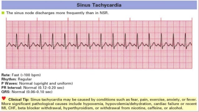 Cardiac Arrythmia In Children
