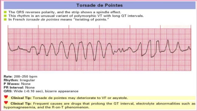 Cardiac arrythmia in children