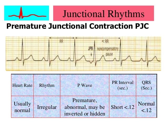Cardiac Arrythmias Cardiac Arrythmias
