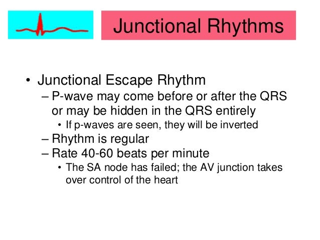 junctional escape rhythm life in teh fast lane junctional escape rhythm life in teh fast lane