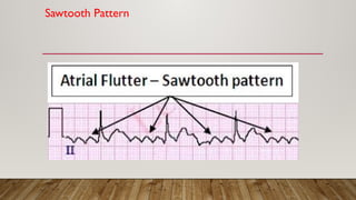 Sawtooth Pattern
 