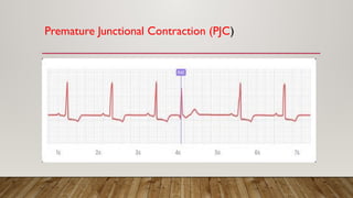 Premature Junctional Contraction (PJC)
 