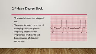 2nd
Heart Degree Block
• PR Interval shorter after dropped
beat.
• .Treatment includes correction of
underlying cause, atropine or
temporary pacemaker for
symptomatic bradycardia and
discontinuation of digoxin if
appropriate.
 