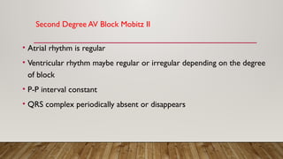 Second Degree AV Block Mobitz II
• Atrial rhythm is regular
• Ventricular rhythm maybe regular or irregular depending on the degree
of block
• P-P interval constant
• QRS complex periodically absent or disappears
 
