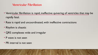 Ventricular Fibrillation
• Ventricular fibrillation is rapid, ineffective quivering of ventricles that may be
rapidly fatal.
• Rate is rapid and uncoordinated, with ineffective contractions
• Rhythm is chaotic
• QRS complexes wide and irregular
• P wave is not seen
• PR interval is not seen
 