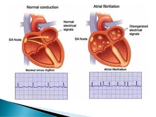 Cardiac Arrhythmia 