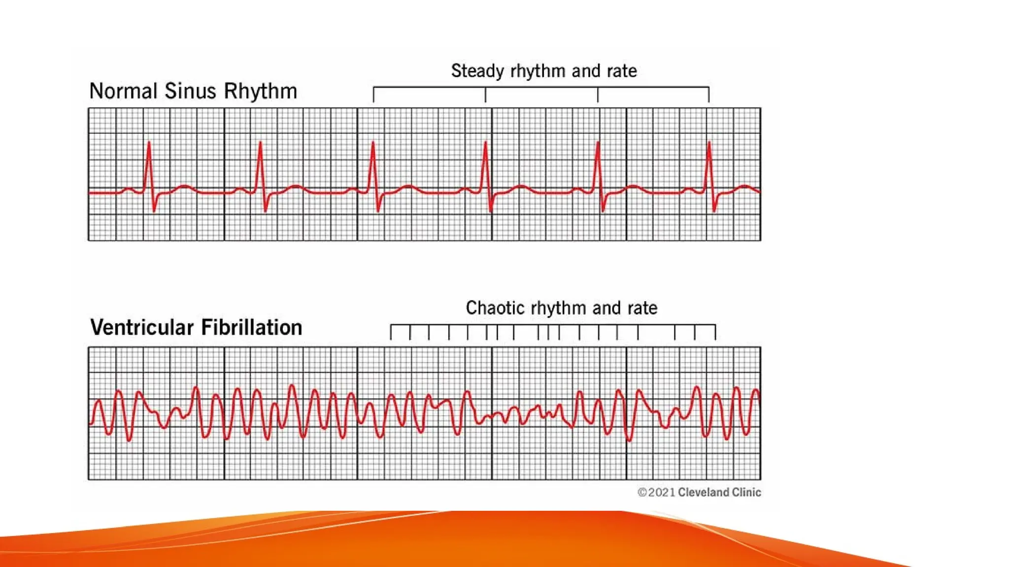 CARDIAC ARRYTHMIAS AND ITS NURSING MANAGEMENT | PPTX