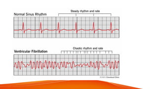 CARDIAC ARRYTHMIAS AND ITS NURSING MANAGEMENT | PPTX