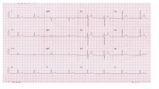 cardiac Arrythmias1 topic for emergency nursing student AAUP .pptx