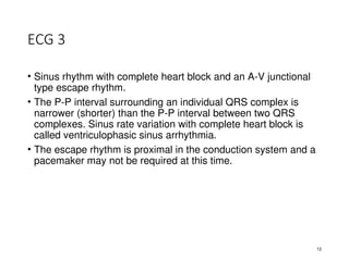 Cardiac Arrythmias Tanisha Baladia Internal Medicine.ppt