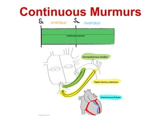Continuous Murmurs
 